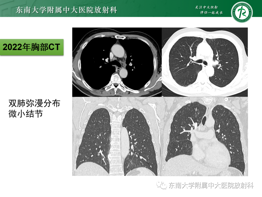 影像PPT - 【PPT】心脏结节病MR表现-25