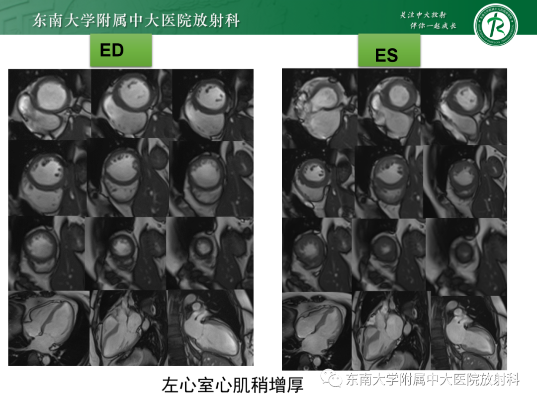 影像PPT - 【PPT】心脏结节病MR表现-38