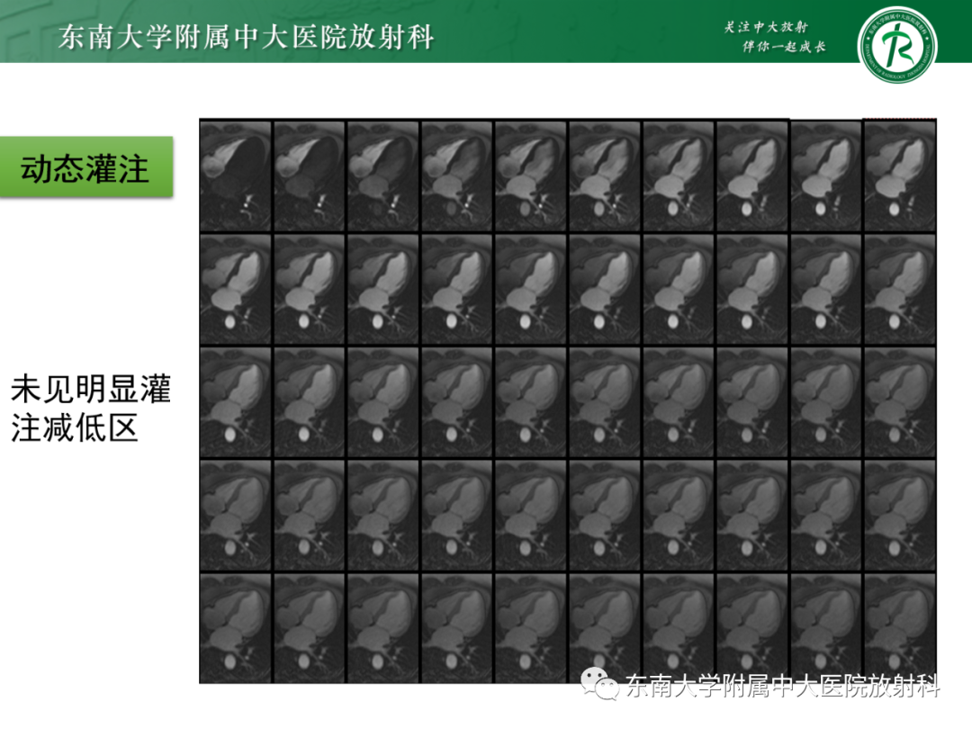 影像PPT - 【PPT】心脏结节病MR表现-40