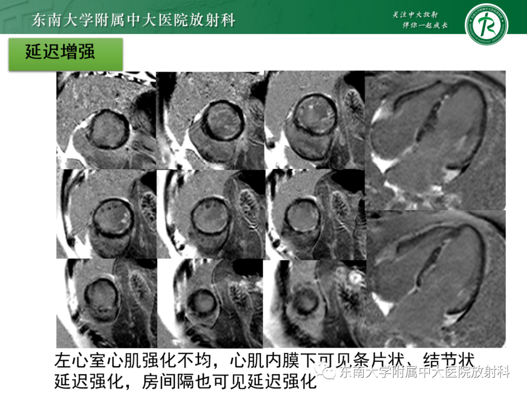 影像PPT - 【PPT】心脏结节病MR表现-41