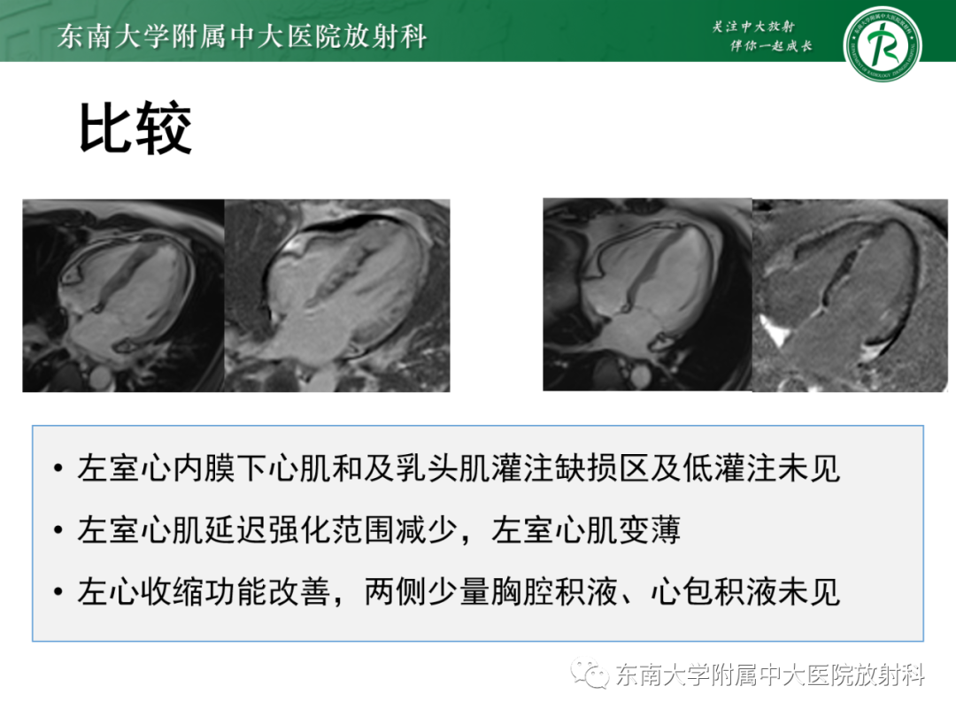 影像PPT - 【PPT】心脏结节病MR表现-44