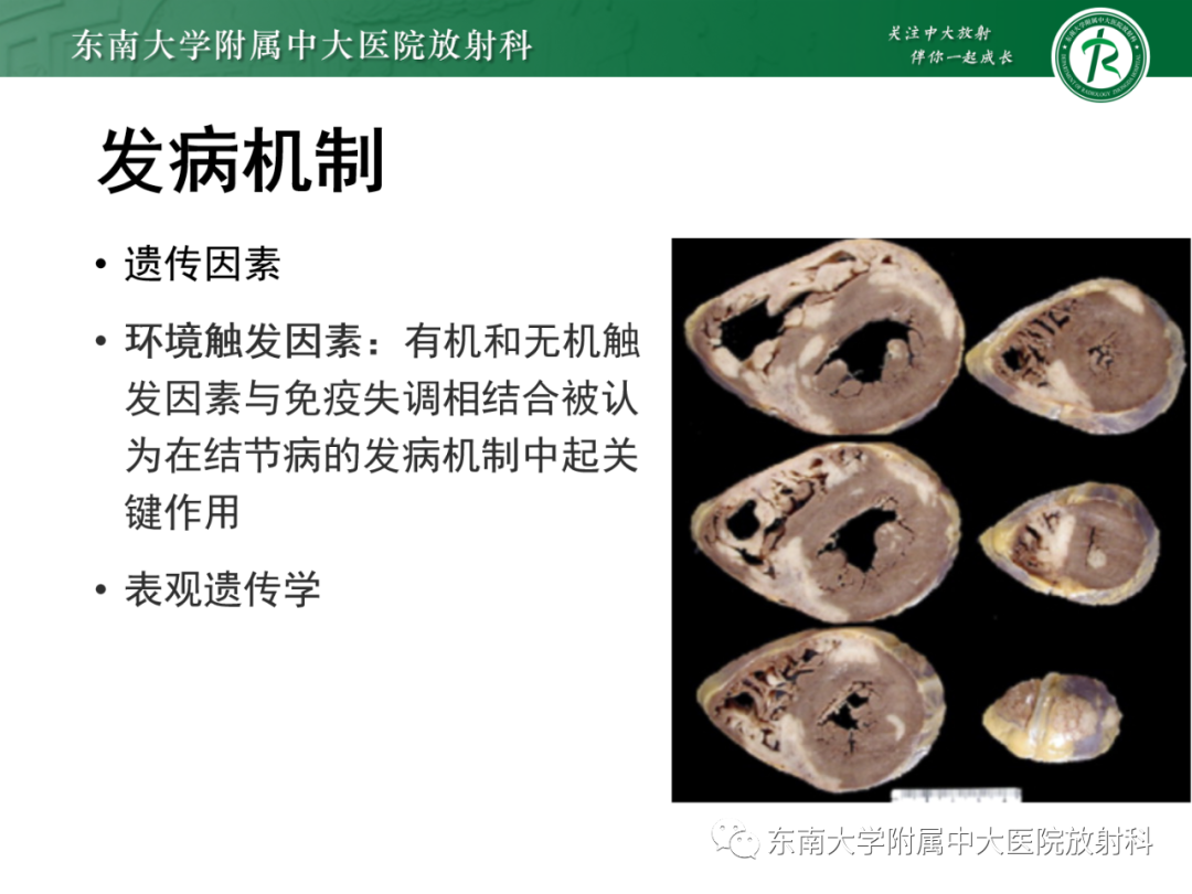 影像PPT - 【PPT】心脏结节病MR表现-49