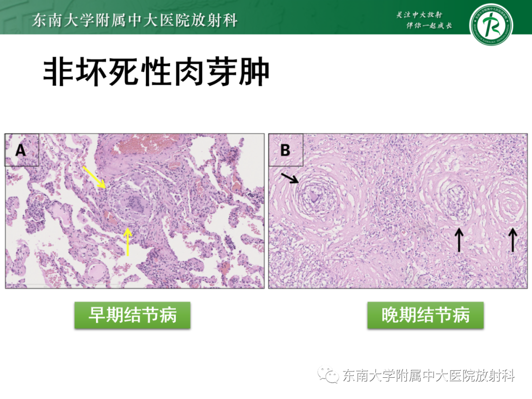 影像PPT - 【PPT】心脏结节病MR表现-52