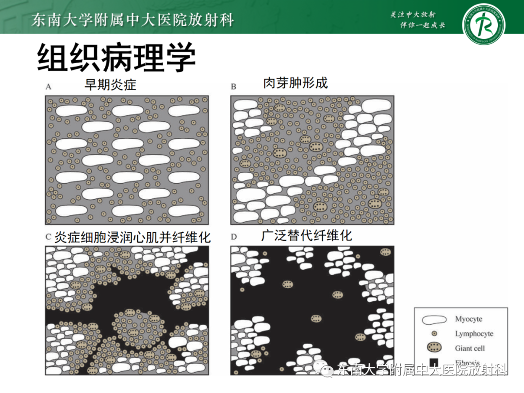 影像PPT - 【PPT】心脏结节病MR表现-53
