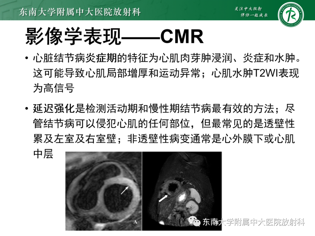 影像PPT - 【PPT】心脏结节病MR表现-58