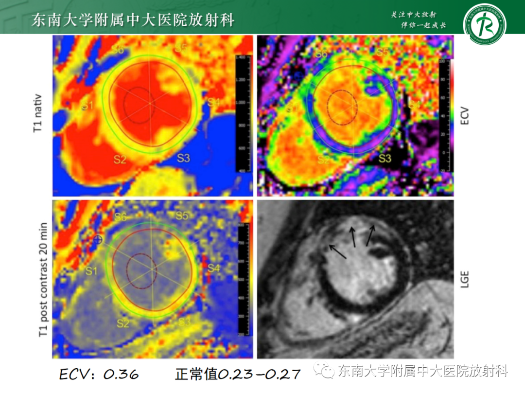影像PPT - 【PPT】心脏结节病MR表现-60
