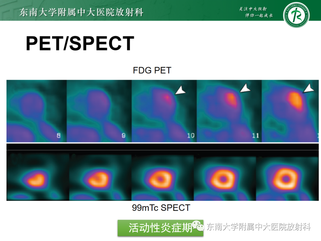 影像PPT - 【PPT】心脏结节病MR表现-63