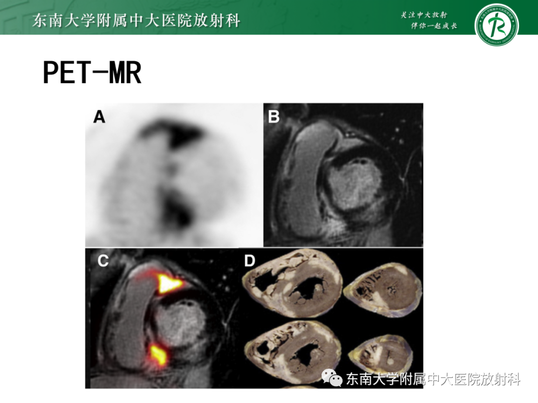 影像PPT - 【PPT】心脏结节病MR表现-65