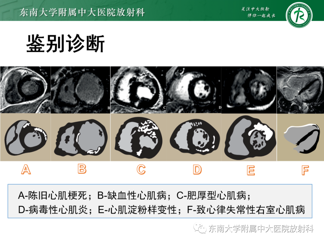 影像PPT - 【PPT】心脏结节病MR表现-68