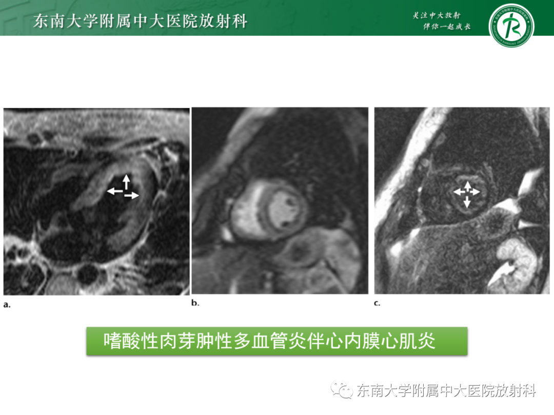 影像PPT - 【PPT】心脏结节病MR表现-74