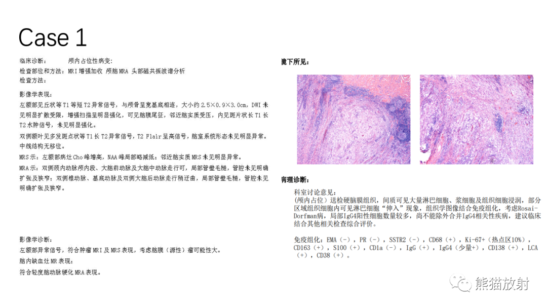 影像PPT - 【病例】罗道病/窦性组织细胞增生伴巨大淋巴结病RDD VS 孤立性纤维瘤-12
