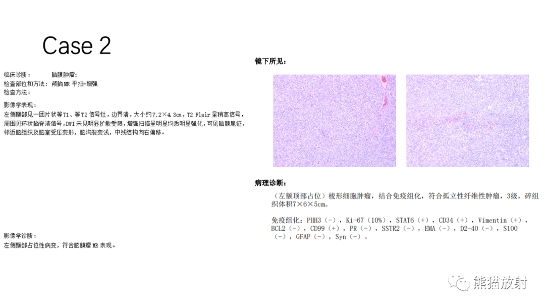 影像PPT - 【病例】罗道病/窦性组织细胞增生伴巨大淋巴结病RDD VS 孤立性纤维瘤-13