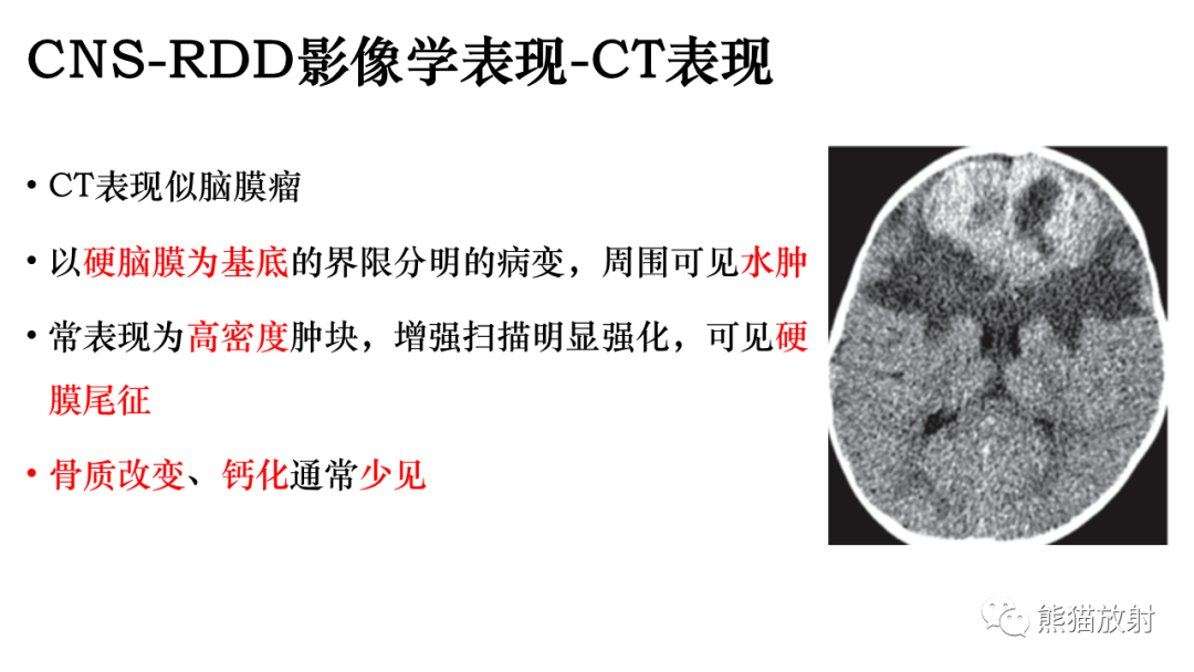 影像PPT - 【病例】罗道病/窦性组织细胞增生伴巨大淋巴结病RDD VS 孤立性纤维瘤-19