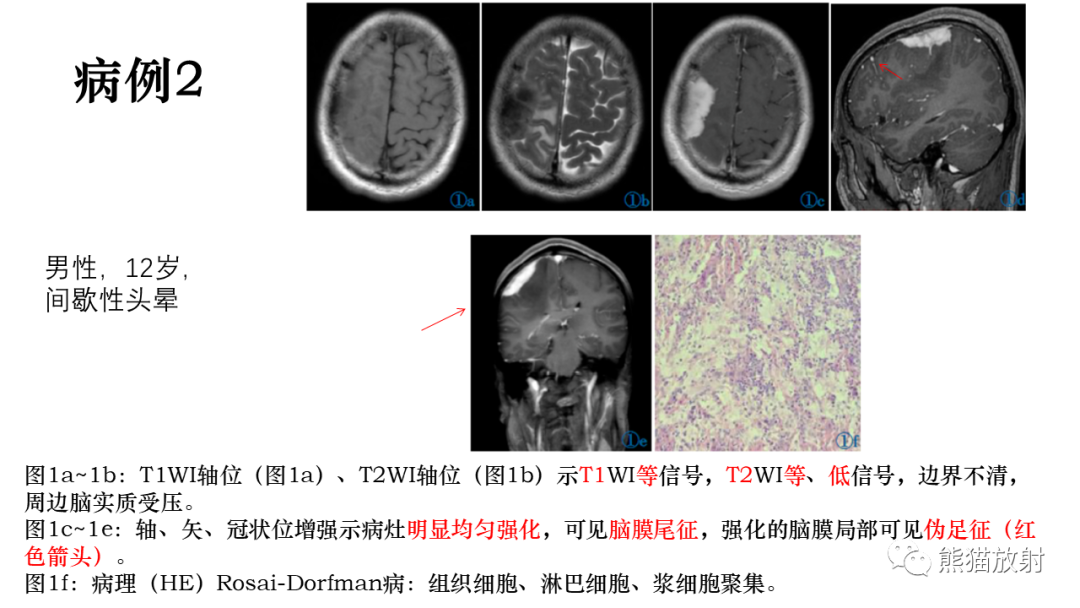 影像PPT - 【病例】罗道病/窦性组织细胞增生伴巨大淋巴结病RDD VS 孤立性纤维瘤-22