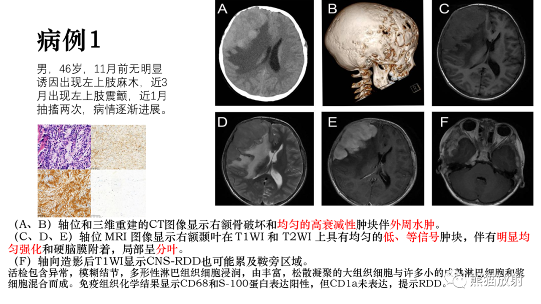 影像PPT - 【病例】罗道病/窦性组织细胞增生伴巨大淋巴结病RDD VS 孤立性纤维瘤-21
