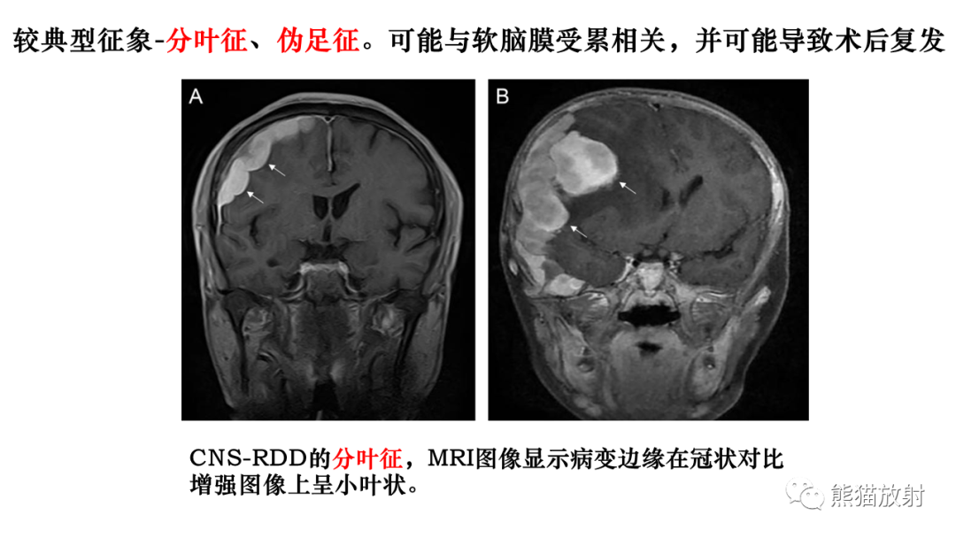 影像PPT - 【病例】罗道病/窦性组织细胞增生伴巨大淋巴结病RDD VS 孤立性纤维瘤-23