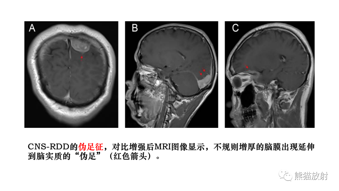 影像PPT - 【病例】罗道病/窦性组织细胞增生伴巨大淋巴结病RDD VS 孤立性纤维瘤-24