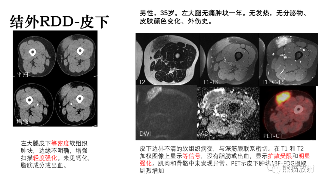 影像PPT - 【病例】罗道病/窦性组织细胞增生伴巨大淋巴结病RDD VS 孤立性纤维瘤-27