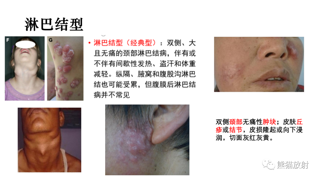 影像PPT - 【病例】罗道病/窦性组织细胞增生伴巨大淋巴结病RDD VS 孤立性纤维瘤-26