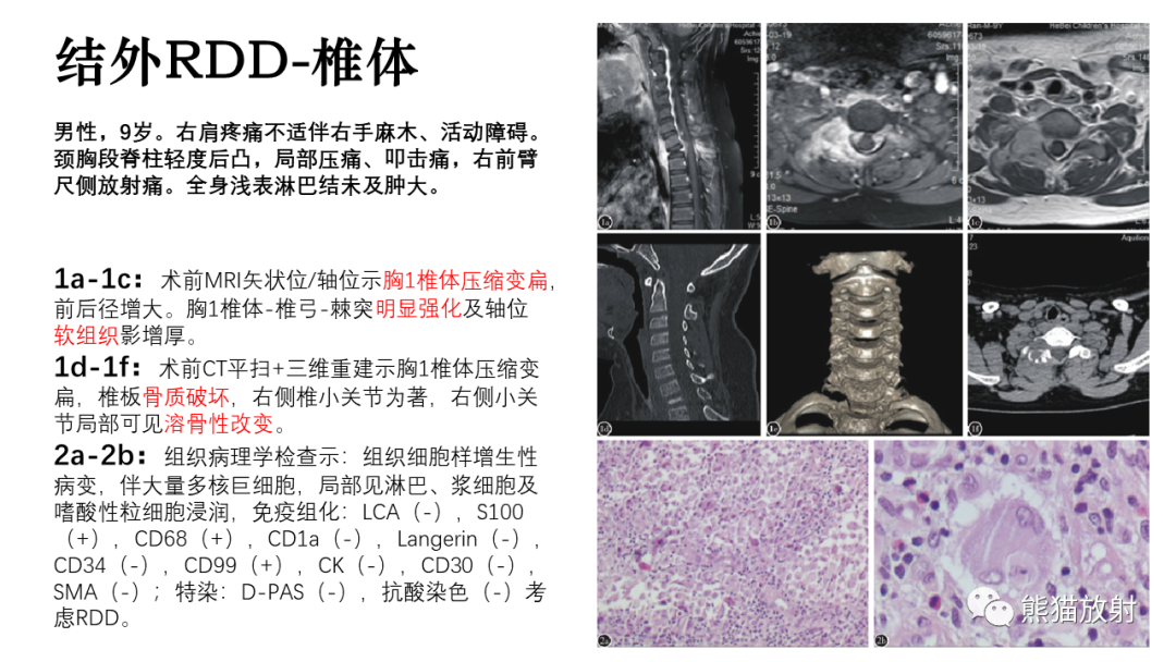 影像PPT - 【病例】罗道病/窦性组织细胞增生伴巨大淋巴结病RDD VS 孤立性纤维瘤-29