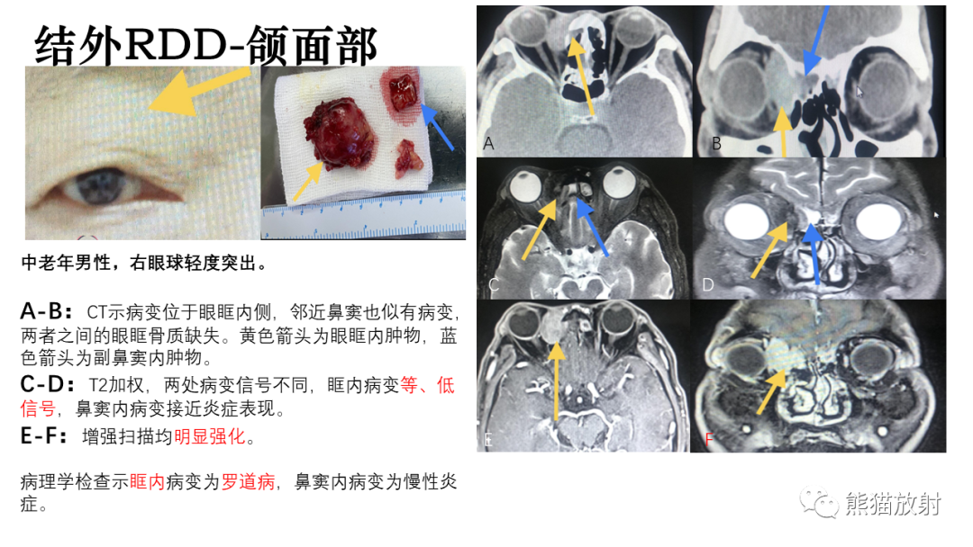 影像PPT - 【病例】罗道病/窦性组织细胞增生伴巨大淋巴结病RDD VS 孤立性纤维瘤-28