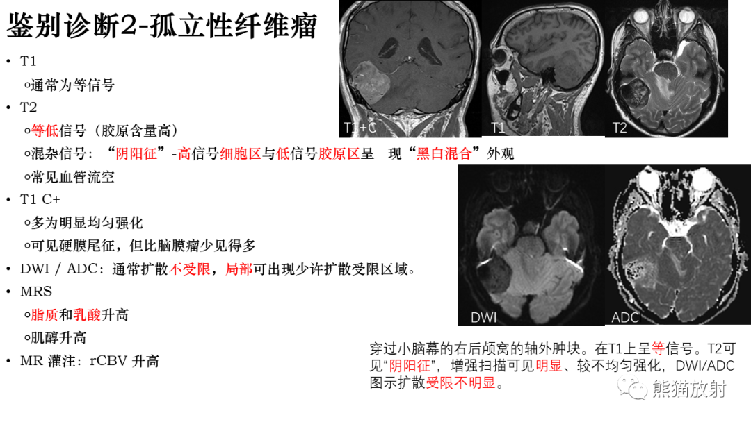 影像PPT - 【病例】罗道病/窦性组织细胞增生伴巨大淋巴结病RDD VS 孤立性纤维瘤-32