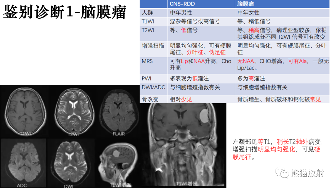 影像PPT - 【病例】罗道病/窦性组织细胞增生伴巨大淋巴结病RDD VS 孤立性纤维瘤-31