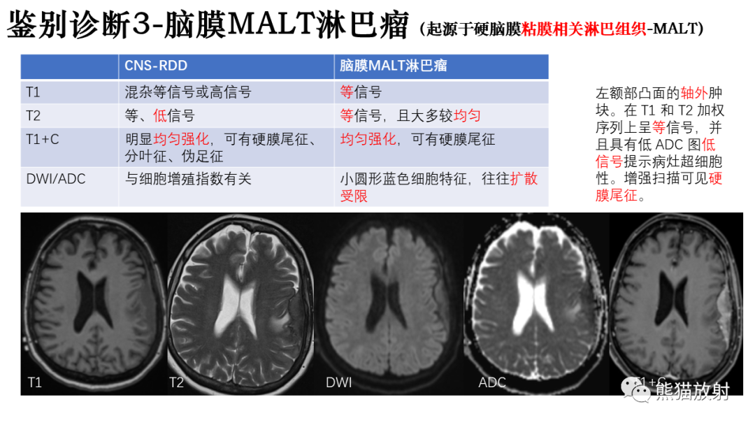影像PPT - 【病例】罗道病/窦性组织细胞增生伴巨大淋巴结病RDD VS 孤立性纤维瘤-33