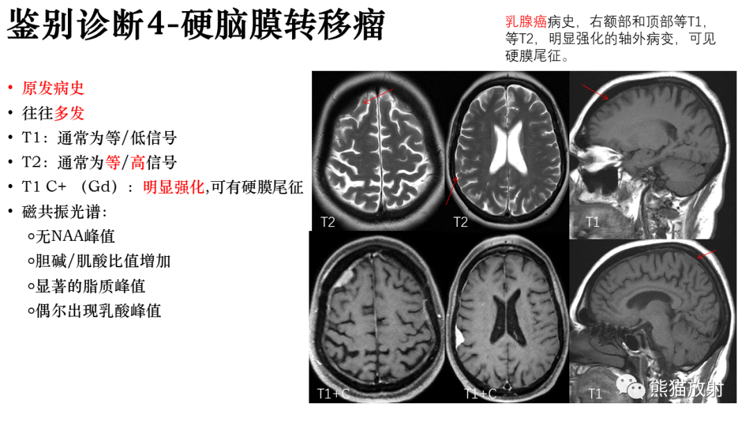 影像PPT - 【病例】罗道病/窦性组织细胞增生伴巨大淋巴结病RDD VS 孤立性纤维瘤-34