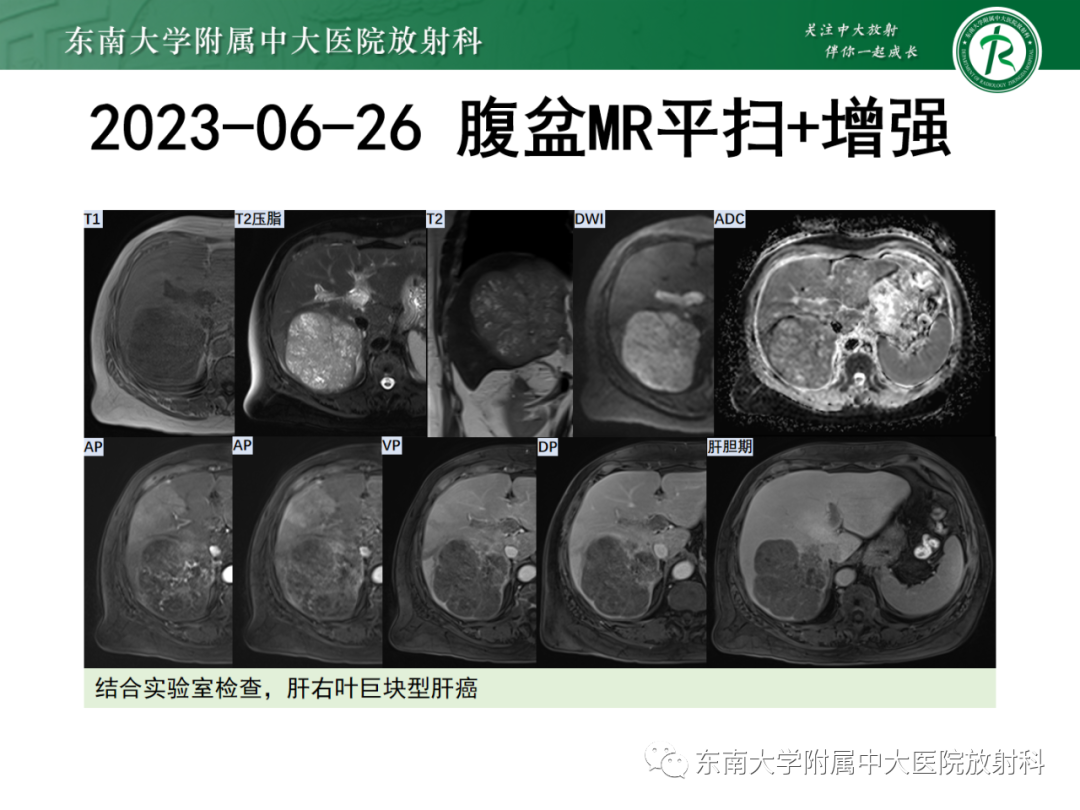 影像PPT - 【PPT】消化系统介入术后特殊并发症-5 影像PPT - 【PPT】消化系统介入术后特殊并发症-5