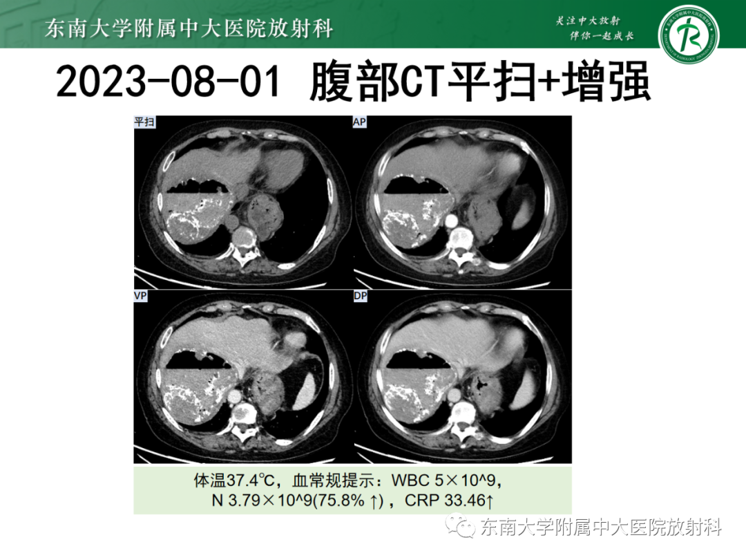 影像PPT - 【PPT】消化系统介入术后特殊并发症-6 影像PPT - 【PPT】消化系统介入术后特殊并发症-6
