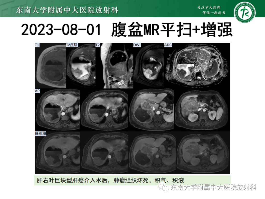 影像PPT - 【PPT】消化系统介入术后特殊并发症-7 影像PPT - 【PPT】消化系统介入术后特殊并发症-7
