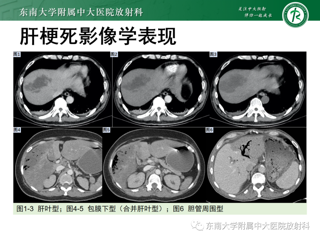 影像PPT - 【PPT】消化系统介入术后特殊并发症-15 影像PPT - 【PPT】消化系统介入术后特殊并发症-15
