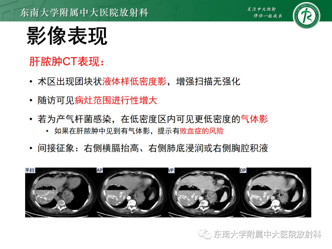 影像PPT - 【PPT】消化系统介入术后特殊并发症-18 影像PPT - 【PPT】消化系统介入术后特殊并发症-18