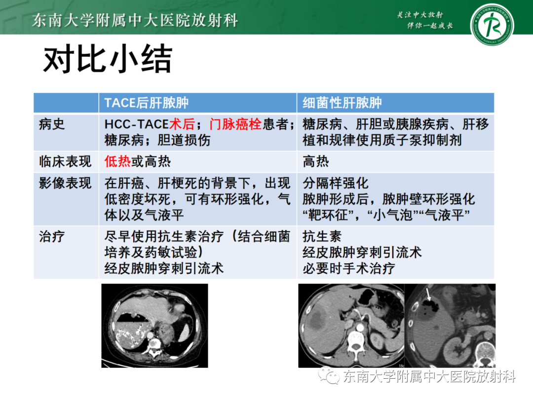 影像PPT - 【PPT】消化系统介入术后特殊并发症-20 影像PPT - 【PPT】消化系统介入术后特殊并发症-20