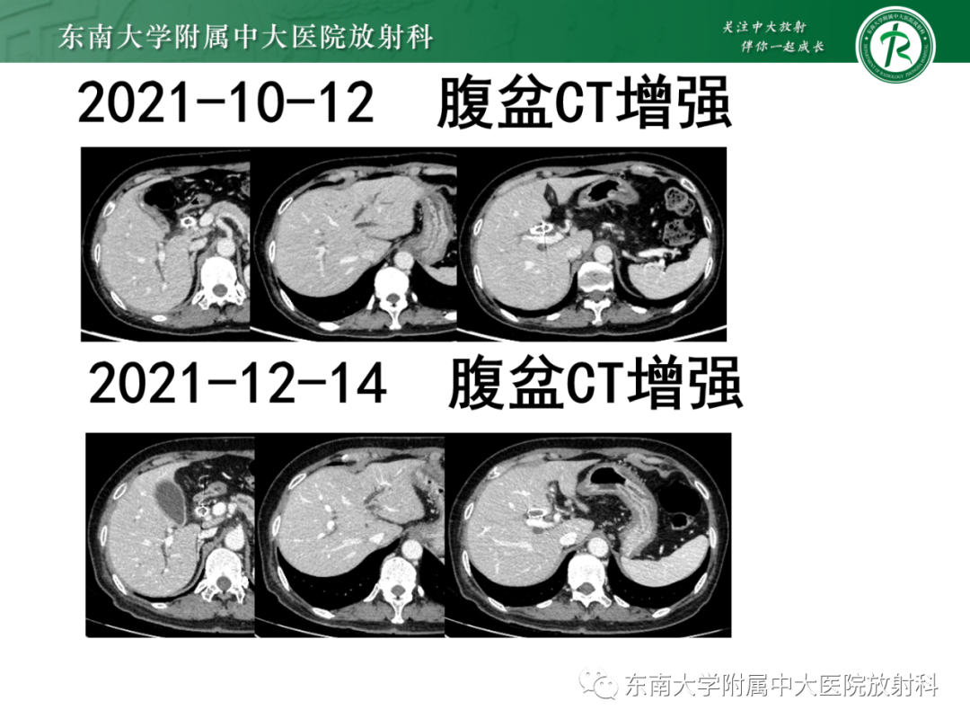 影像PPT - 【PPT】消化系统介入术后特殊并发症-22 影像PPT - 【PPT】消化系统介入术后特殊并发症-22