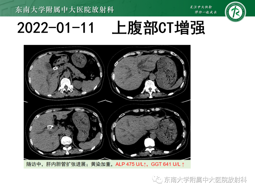 影像PPT - 【PPT】消化系统介入术后特殊并发症-23 影像PPT - 【PPT】消化系统介入术后特殊并发症-23