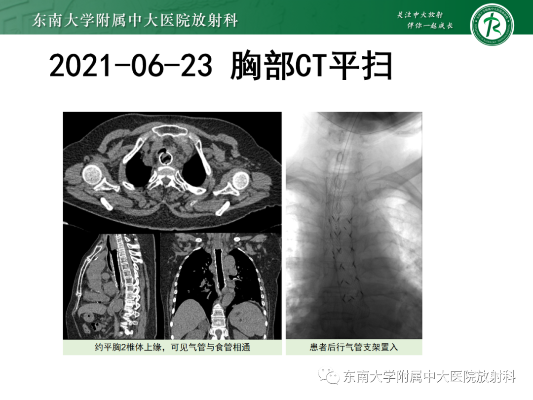 影像PPT - 【PPT】消化系统介入术后特殊并发症-29 影像PPT - 【PPT】消化系统介入术后特殊并发症-29