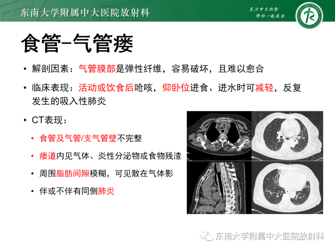 影像PPT - 【PPT】消化系统介入术后特殊并发症-35 影像PPT - 【PPT】消化系统介入术后特殊并发症-35