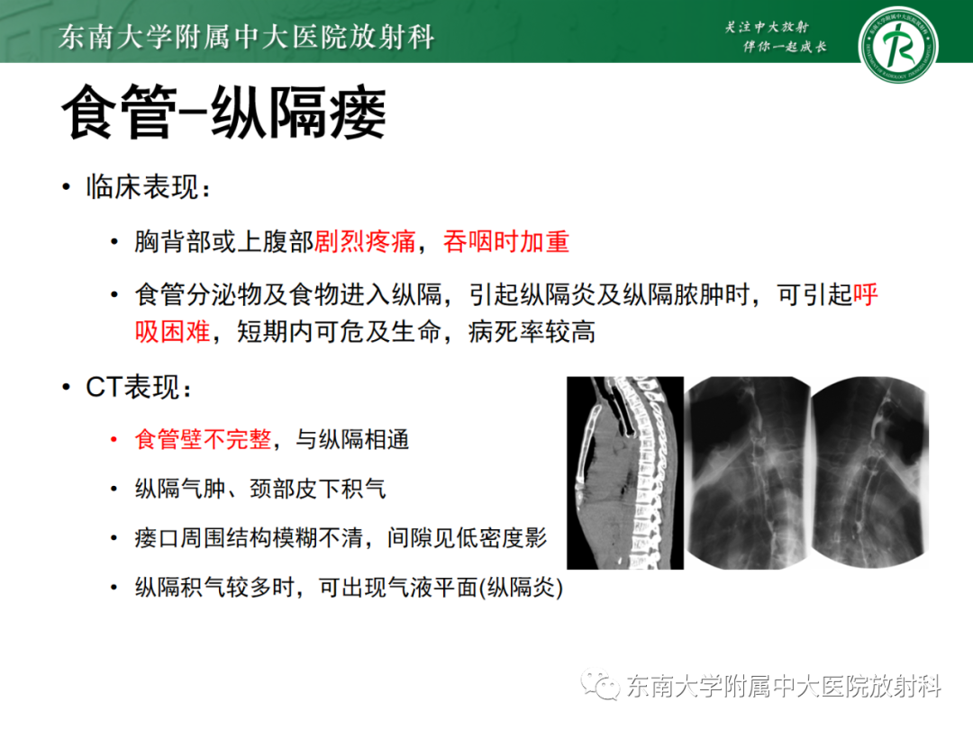 影像PPT - 【PPT】消化系统介入术后特殊并发症-37 影像PPT - 【PPT】消化系统介入术后特殊并发症-37