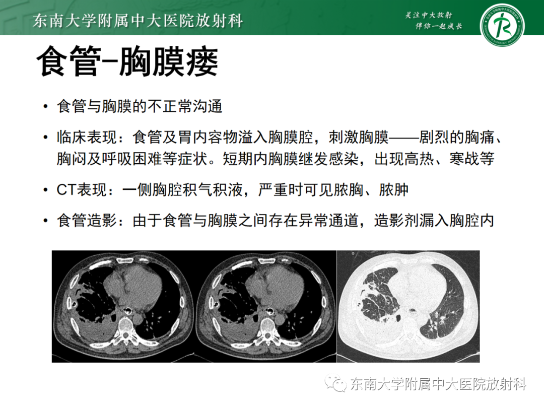 影像PPT - 【PPT】消化系统介入术后特殊并发症-38 影像PPT - 【PPT】消化系统介入术后特殊并发症-38