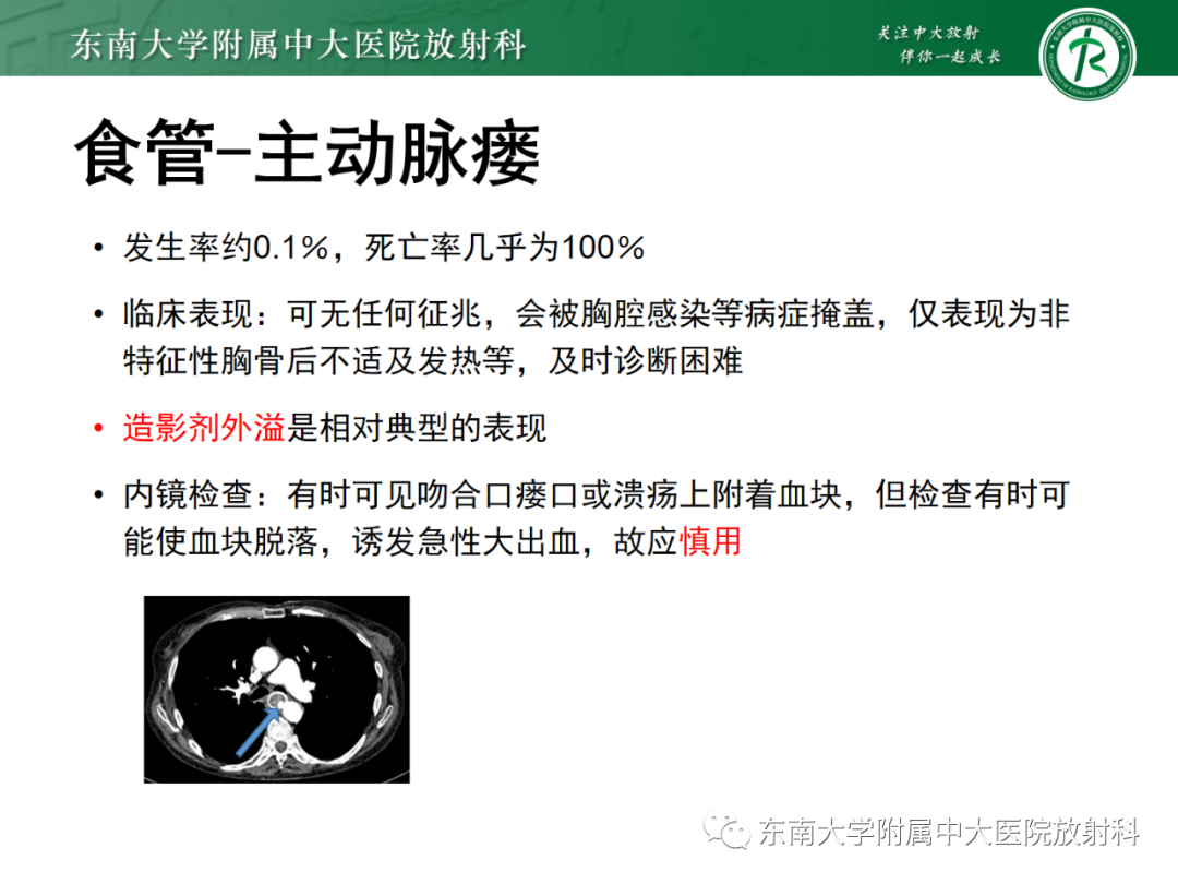 影像PPT - 【PPT】消化系统介入术后特殊并发症-39 影像PPT - 【PPT】消化系统介入术后特殊并发症-39