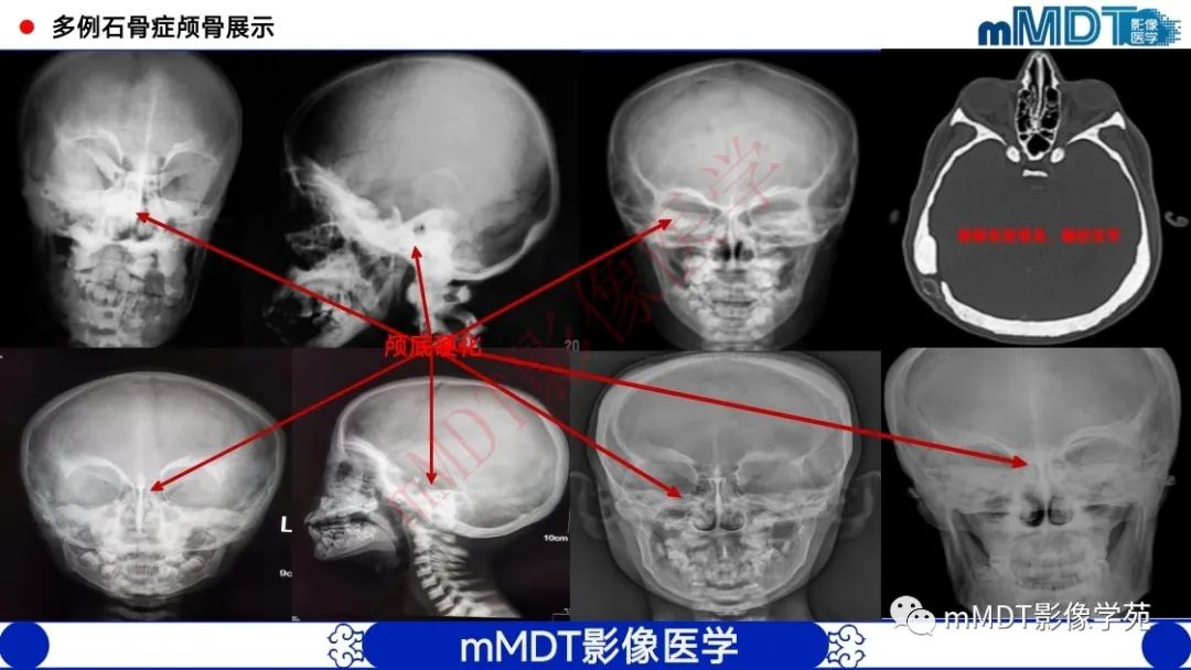 影像PPT - 【PPT】颅骨“弥漫性”增厚影像剖析-8