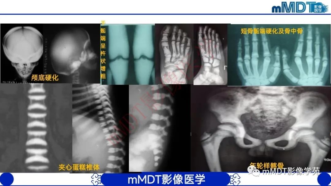 影像PPT - 【PPT】颅骨“弥漫性”增厚影像剖析-7