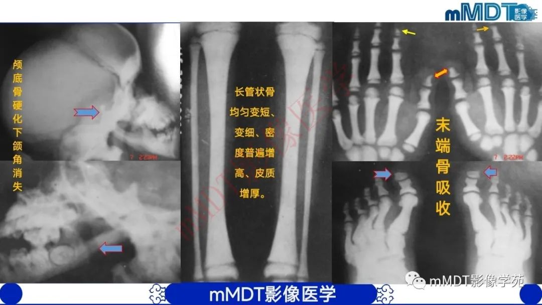 影像PPT - 【PPT】颅骨“弥漫性”增厚影像剖析-10