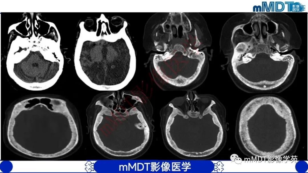 影像PPT - 【PPT】颅骨“弥漫性”增厚影像剖析-14