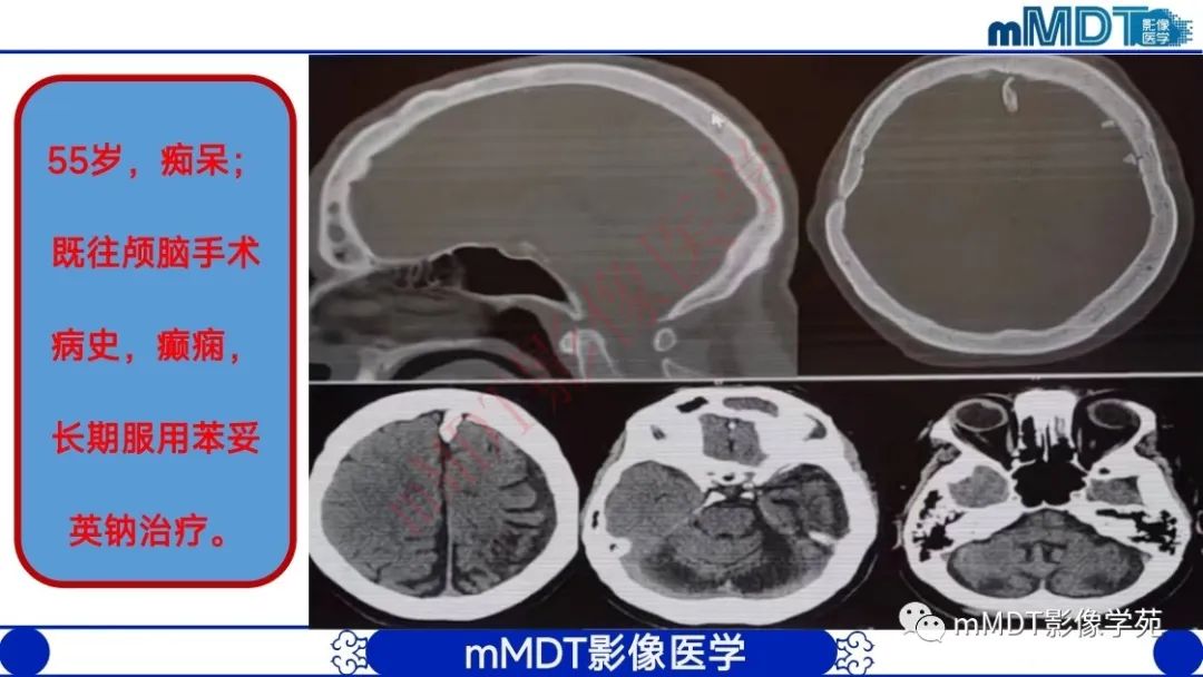 影像PPT - 【PPT】颅骨“弥漫性”增厚影像剖析-15