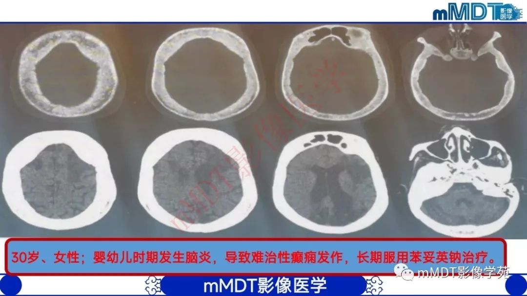 影像PPT - 【PPT】颅骨“弥漫性”增厚影像剖析-16