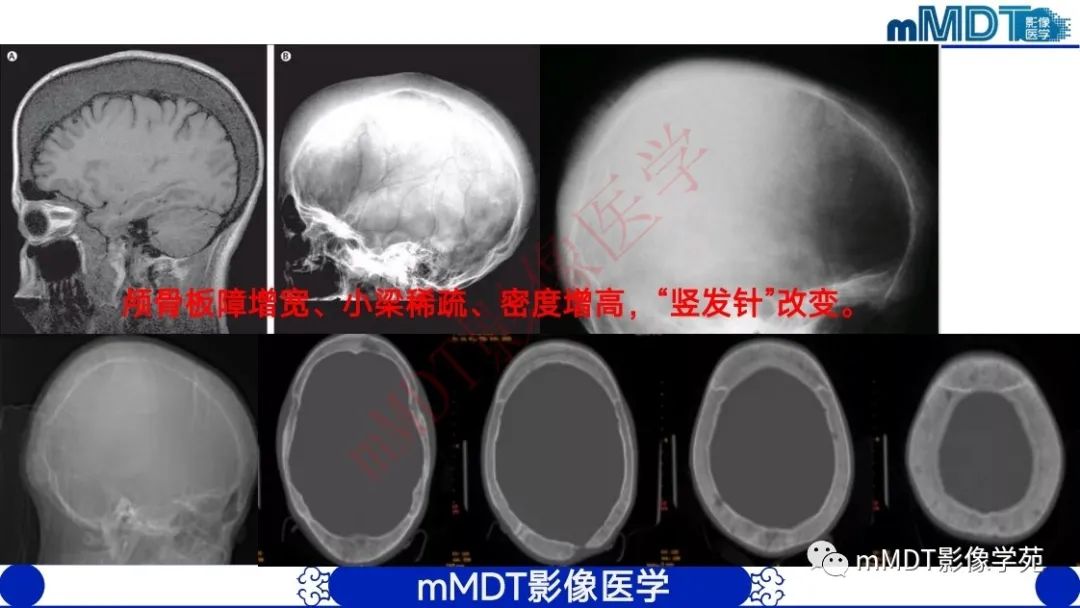 影像PPT - 【PPT】颅骨“弥漫性”增厚影像剖析-21