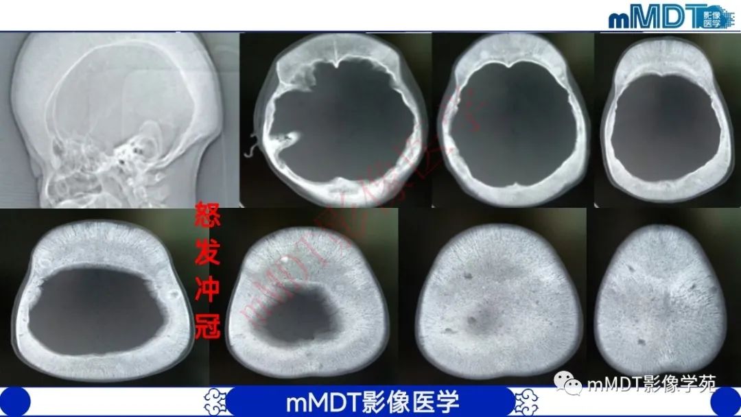影像PPT - 【PPT】颅骨“弥漫性”增厚影像剖析-22